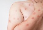 SES alerta para monitoramento de casos de Mpox em MT após avanço de variante em Rondônia