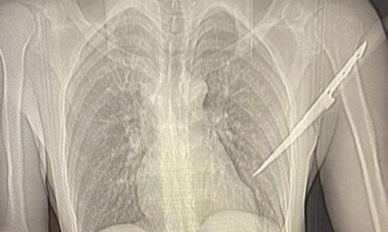 Após agressão, mulher 'crava' faca nas costas de companheiro em Querência